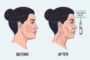 «صورت اوزمپیکی» چیست؟/ نگرانی تازه این روزها؛ چرا کاهش وزن چهره را تغییر میدهد؟